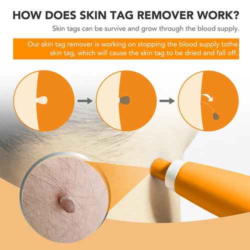 Load image into Gallery viewer, Rubber Rings Face Mole Removal Tool Kits Safety Painless Remove Skin Wart Kits Face Beauty Accessories for Neck Chin Back
