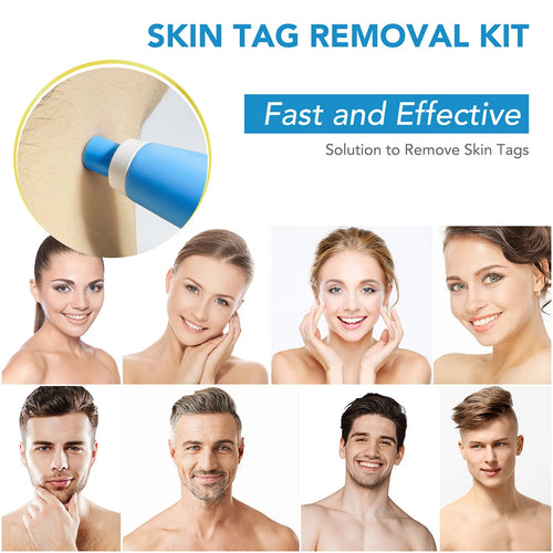 Load image into Gallery viewer, Rubber Rings Face Mole Removal Tool Kits Safety Painless Remove Skin Wart Kits Face Beauty Accessories for Neck Chin Back
