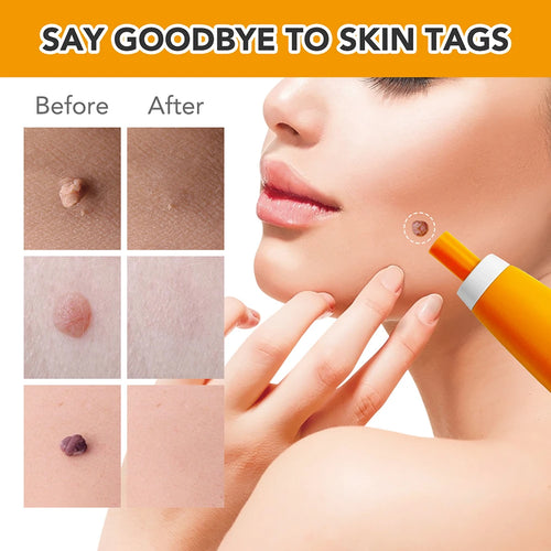 Load image into Gallery viewer, Rubber Rings Face Mole Removal Tool Kits Safety Painless Remove Skin Wart Kits Face Beauty Accessories for Neck Chin Back
