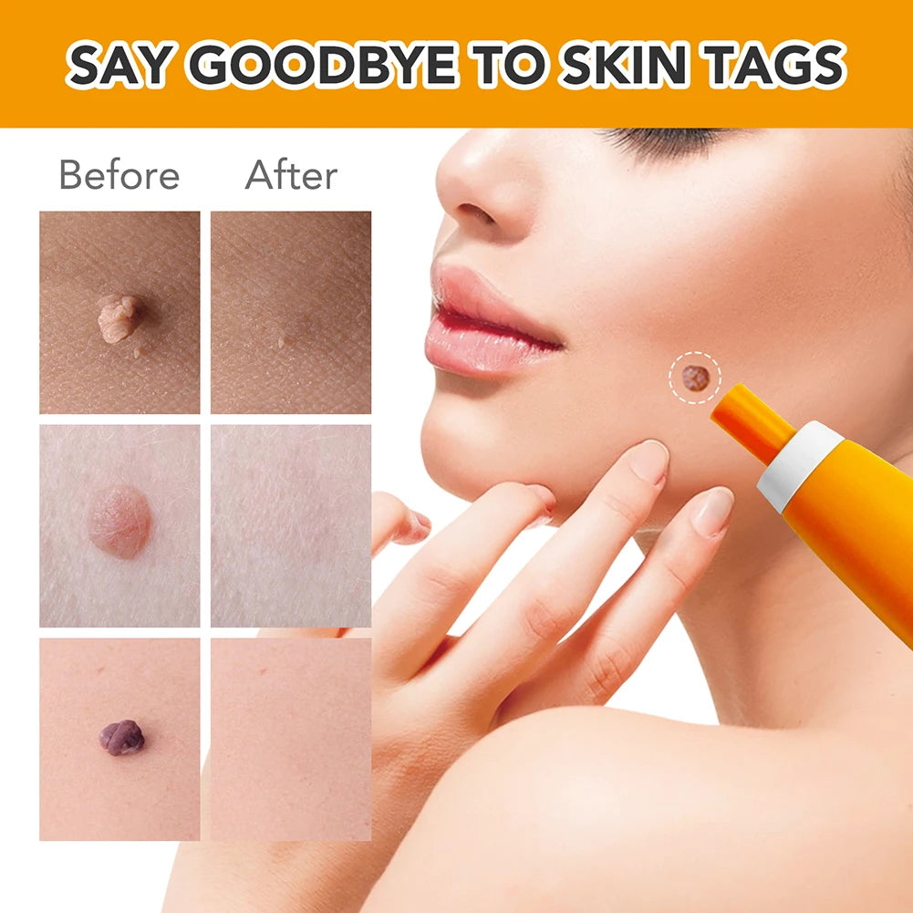 Rubber Rings Face Mole Removal Tool Kits Safety Painless Remove Skin Wart Kits Face Beauty Accessories for Neck Chin Back